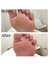 りく/角質ケア75分