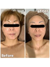 エリーザベル(Elisa Bell)/小顔矯正コルギ症例写真