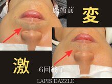 ラピスダズル(LAPIS DAZZLE)/ひげ脱毛☆途中経過(6回終了)