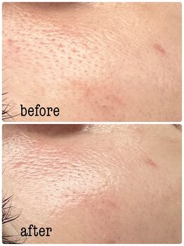 シエル ブルー(Ciel Blue)/Before→After