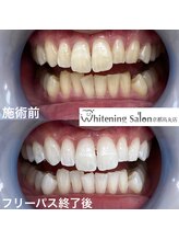 ホワイトニングサロン 京都烏丸店/ホワイトニング施術例