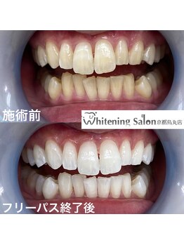 ホワイトニングサロン 京都烏丸店/ホワイトニング施術例