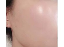 ハーブピーリング 心斎橋/