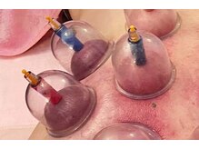 スイクウ ネオ(neo)/カッピング