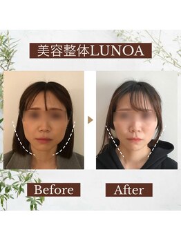 ルノア 梅田院(LUNOA)/小顔矯正[梅田/小顔/エラ張り]