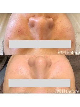 エステサロン ’Olu ’Oluの写真/その毛穴悩み、諦めないで!黒ずみ・開きを徹底改善。ハーブの力で毛穴レスなツヤ肌へ導きます