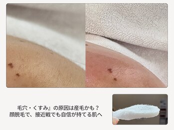 ボーテラボ 大宮(beaute LABO)の写真/メイク崩れ・トーンダウンにさようなら！顔脱毛で、ワントーン明るい透明肌へ。