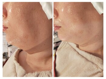 ベリッセ(Belisse)/レモンボトル*フェイスライン