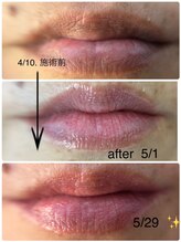 リュミエール デスポワール(Lumiere d'espoir)/ROMAPINK ローマピンク