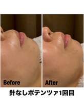 Sスタイルスタジオ 福岡天神/針なしポテンツァ1回目