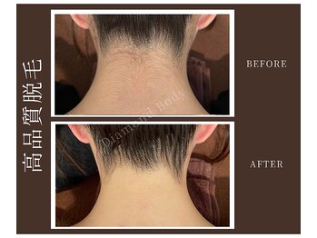 ダイヤモンドボディ プレミアム なかもず店/【高品質脱毛】うなじ