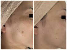 プルメリスタ 八千代緑が丘店/光フェイシャルbefore→after