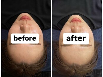 ソセイラボ ウェルネス(SOSEI Lab. wellness)の写真/【美腸鍼×腸もみで体の内側から美しい肌に!】1人1人のお悩みを見極め、しっかりアプローチ◎