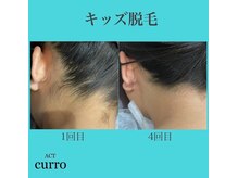 アクト クロ(ACT curro)/【キッズ】脱毛施術