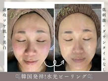 レイズ(RAISE)の雰囲気（当店人気No.1 韓国肌管理　水光ピーリング）