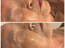 サロンアルーナ(Salon a Luna)/剥離しないハーブピーリング