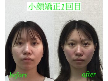 オズ六本木/小顔矯正モニター様1回目施術