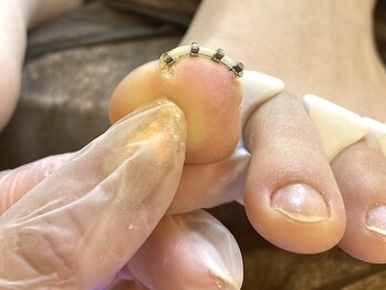 マゼンタの写真/【巻爪の方必見◎】痛みの少ない最新巻爪矯正術★足/爪/靴の専門家による本格施術で長年のお悩みを改善♪