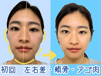 ナチュラルパーフェクトフェイス 新宿/２６才・初回・左右差/新宿小顔