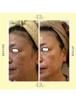 シスタス(Cistus)/ExoLift ビフォーアフター