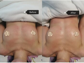 シークレット(Secret)/ビフォーアフター写真