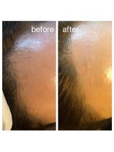 エムユー(Mu)/生え際も綺麗に！