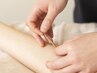 【不調を防ぐ！メンテナンス鍼灸】　好きなことを楽しめる体づくりを◎