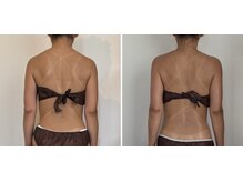 リトリート(Retreat)/月に1回・施術3回の効果