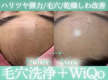 Cスキンケアクリニック 麻布店/ハイドラ＋WiQoピーリング