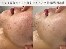 ヴィノ フクシマ(VINO FUKUSHIMA)の雰囲気（施術1回【ニキビ/赤みに圧倒的効果】※途中経過）