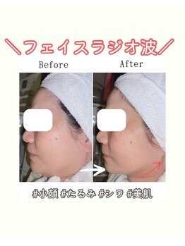 グラシア(gracia)の写真/ラジオ波でハリ・弾力ケア！しわ・たるみを予防して若々しい印象の肌へ♪