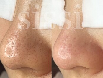 シシィ 二子玉川(sissi)/毛穴エクストラクション