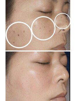 シェアキ(Chez Aki)/シミケアBefore/After