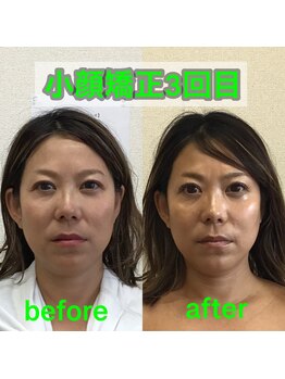 オズ六本木/小顔矯正3回目で若々しい小顔に