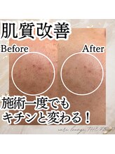 ケア ラウンジ ザ ファースト(THE F1RST)/肌質改善＊ビフォーアフター
