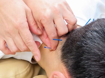 ワセダ接骨鍼灸マッサージ院/鍼灸施術の様子