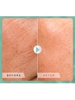 ラグラン銀座メディカルエステ 高輪ゲートウェイ店/希少/シャネル美容液/プラセンタ