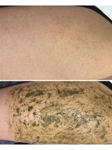 エヌハーブ(NHerb)/二の腕のザラザラ