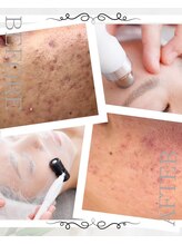 ピュアル 川口(Pual)/繰り返すニキビ/オイリー/赤ら顔