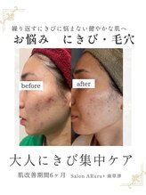 アルルプラス 南草津(ARuru+)/【肌改善】ビフォーアフター