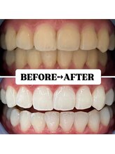 ホワイトニングサロン 豊中/Before&After美白ホワイトニング