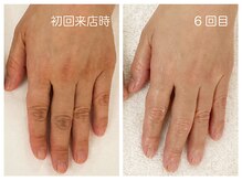 キレイテ 福岡天神店/50代/6回目【天神ハンドケア】