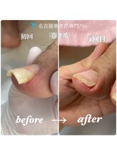 名古屋巻き爪専門Pro/【爪を伸ばして下さい】は危険