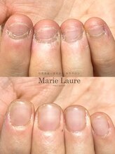 マリーロール 梅田店(Marie Laure)/自爪育成/深爪矯正/ネイルケア