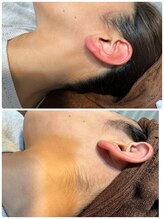 ノノ(nono)/もみあげ～うなじ脱毛♪