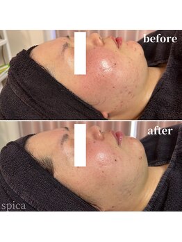 スピカ(Spica)/赤み、ニキビケア☆