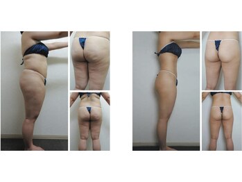 Nビューティー/エンダモロジー×サーモシェイプ