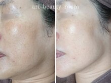 アート ビューティールーム(art beauty room)/☆OPL 光フェイシャル