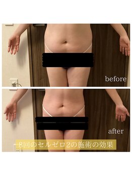 ソーレ(Sole)/セルゼロ2によるダイエット結果