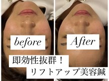 ユアン(YUAN)/美容鍼